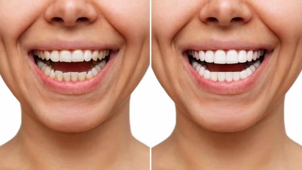 Contact Aspire White for teeth whitening services – Get in touch with Oldham today