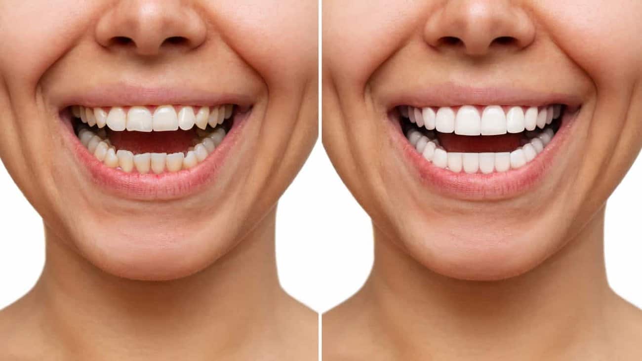 Contact Aspire White for teeth whitening services – Get in touch with Oldham today
