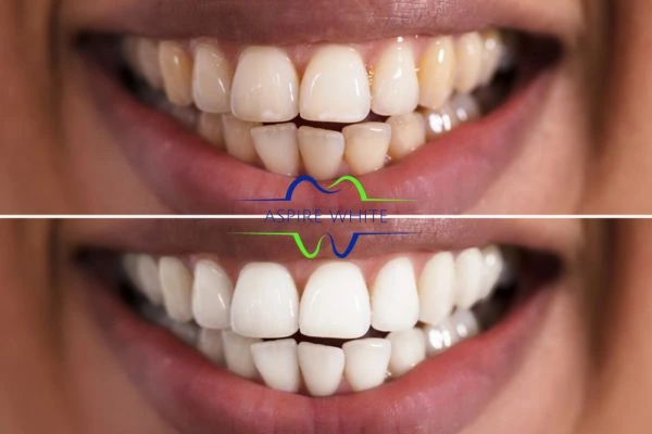 Aspire White customer before and after Oldham results.