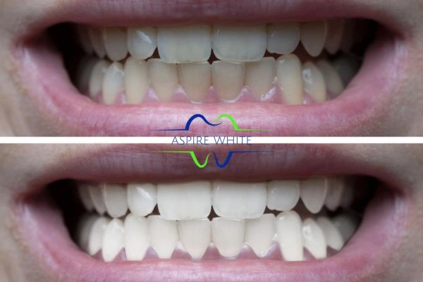 1 hour laser teeth whitening before and after results Oldham