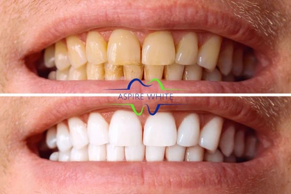 Get noticeable whiter smile in just one hour! Book your teeth whitening treatment Oldham today!