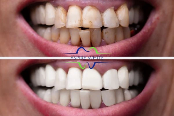 Before and after results of laser teeth whitening Oldham Book in online today!
