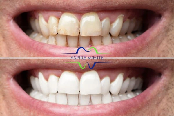 Achieve a radiant smile with professional laser teeth whitening Oldham